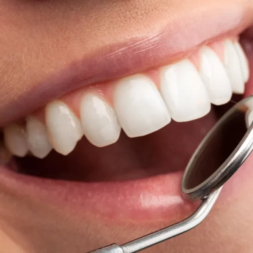 Impianti dentali in un giorno ad Avezzano: guida pratica dal Centro del Dott. Marco Parravano