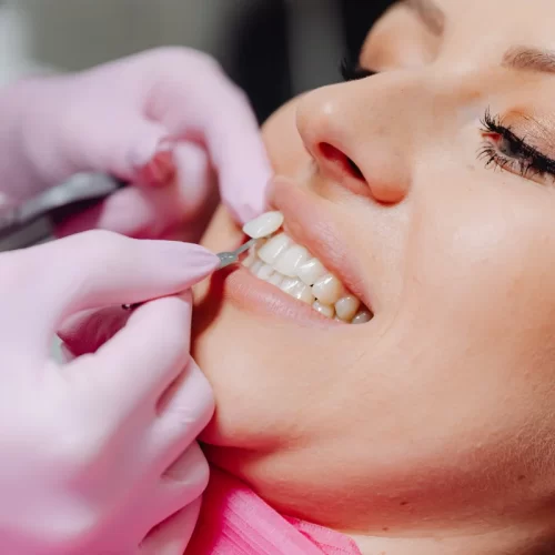 Faccette dentali a Bologna: guida pratica con la Dr.ssa Cristina Desiderio