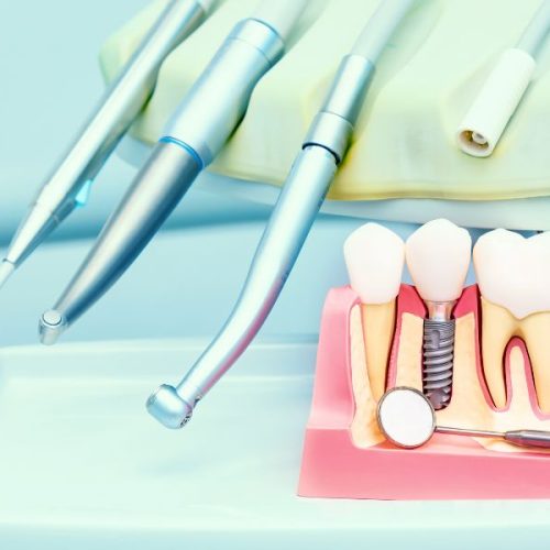 Implantologia in un giorno ad Ascoli Piceno: un sorriso nuovo in poche ore