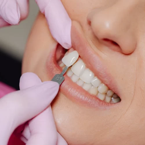 Ortodonzia invisibile a Pagani: guida pratica agli allineatori trasparenti dello Studio Medico Dentistico Tortora